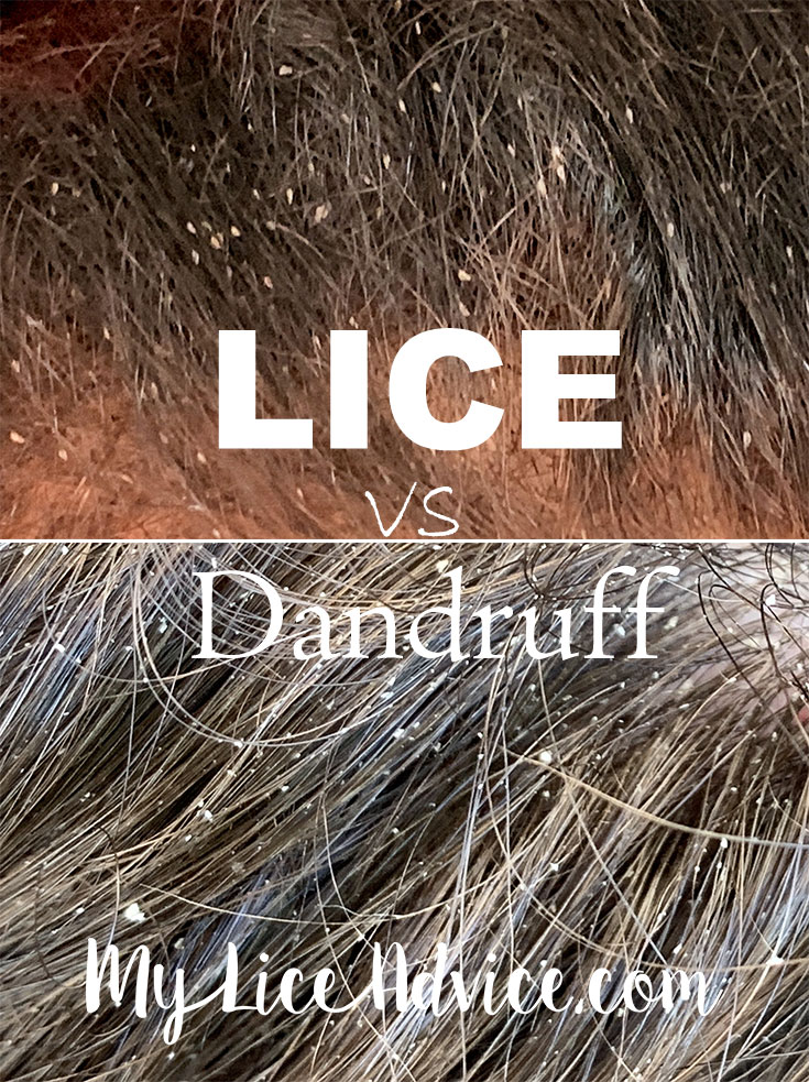 Head Lice Nits Vs Dandruff