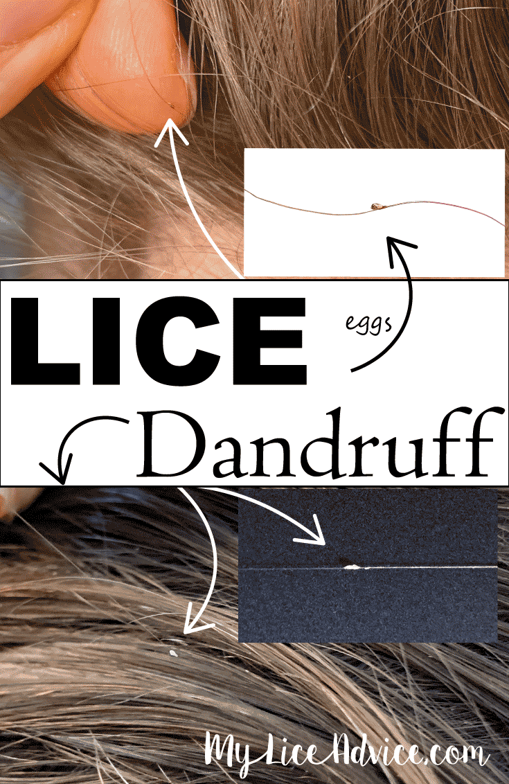 lice eggs or dandruff