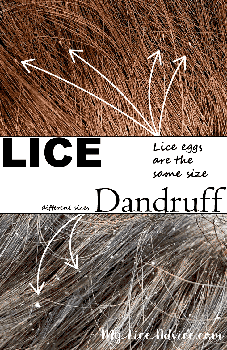 Side-by-side of lice and dandruff size, arrow points to areas lice lay eggs that are all the same size, an arrow points to dandruff