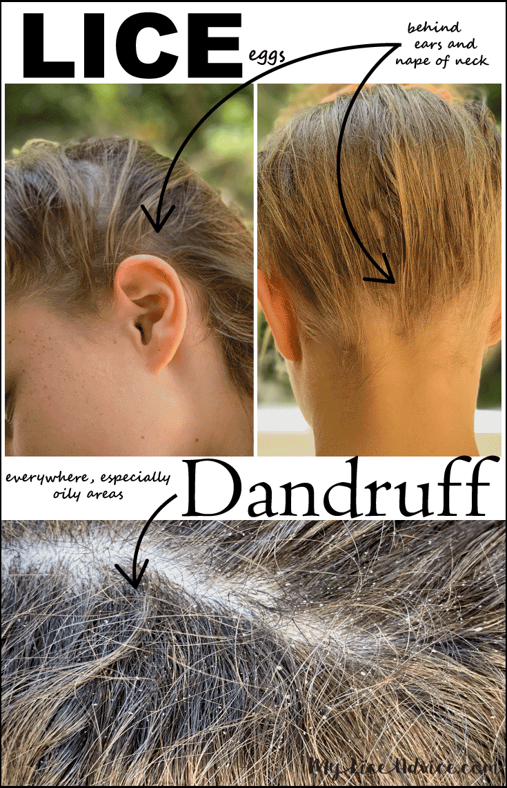 Side-by-side of lice and dandruff areas, an arrow points to areas lice lay eggs, an arrow points to dandruff in the hair