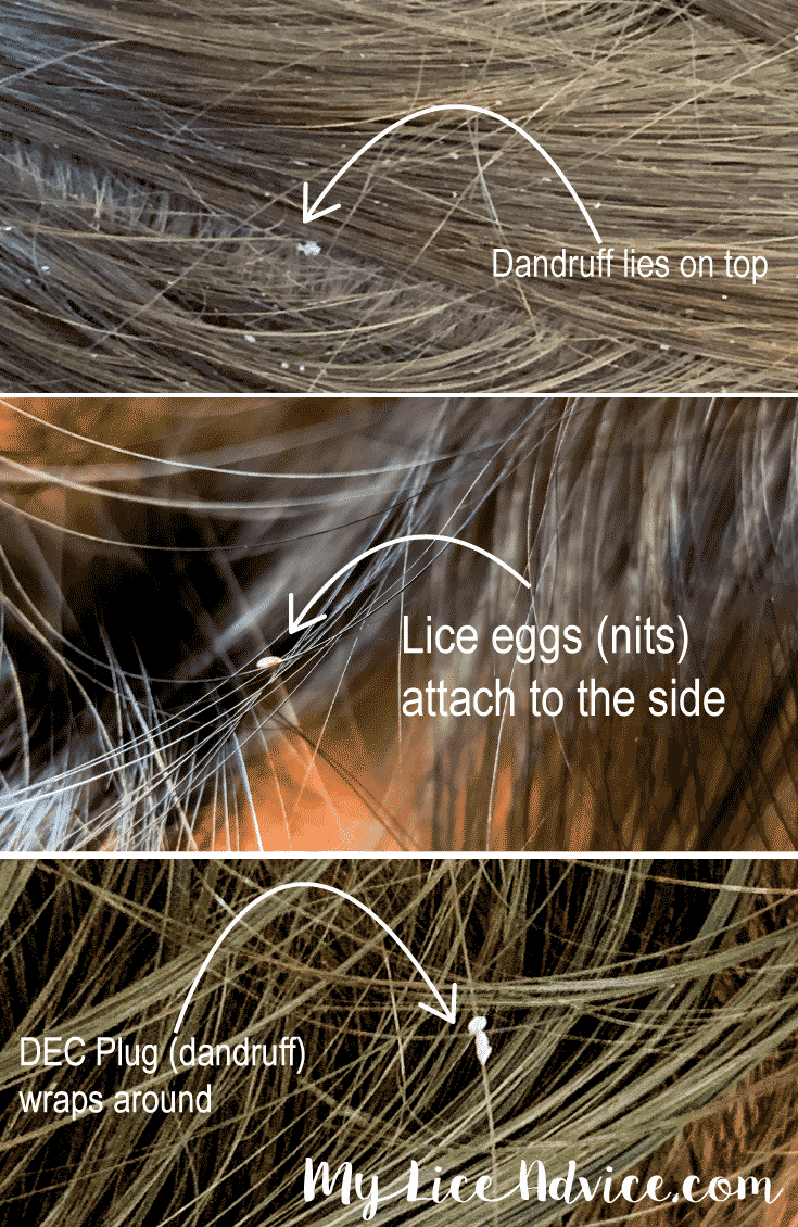 Side-by-side comparing lice egg and dandruff location on hair strand. Lice eggs appear as a golden leaf on side, dandruff appears as a snowflake on top.
