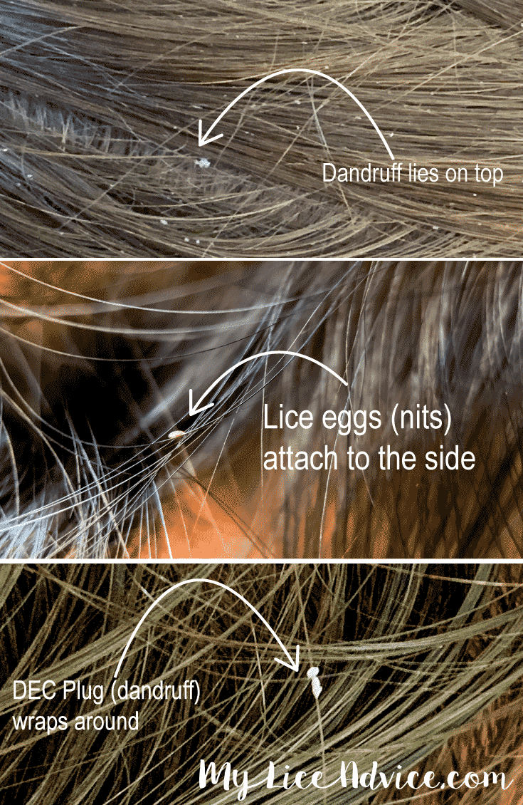 lice eggs or dandruff