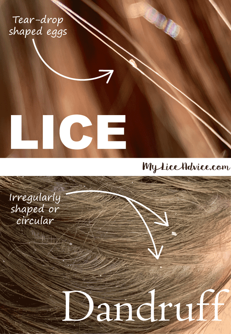 Side-by-side lice egg vs dandruff shape. Tear-dropped lice egg is attached to a single hair strand. Irregularly shaped dandruff in the hair.