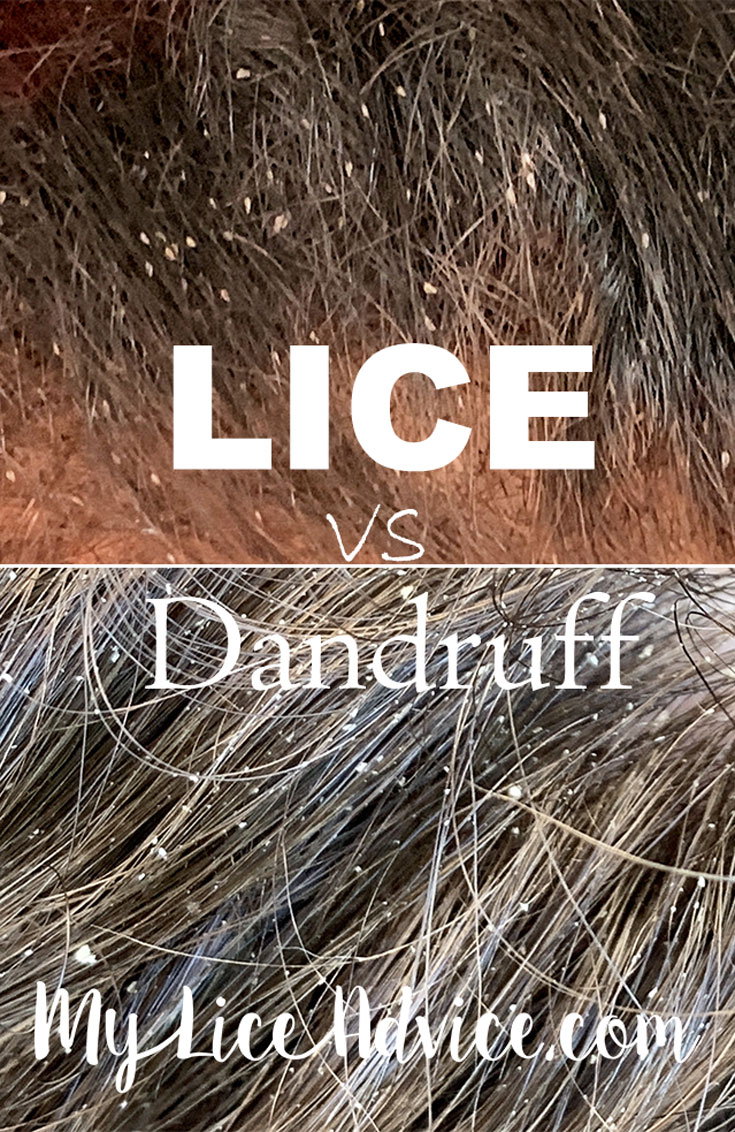 Side-by-side of lice and dandruff in the hair. Top image is lice, bottom image is dandruff