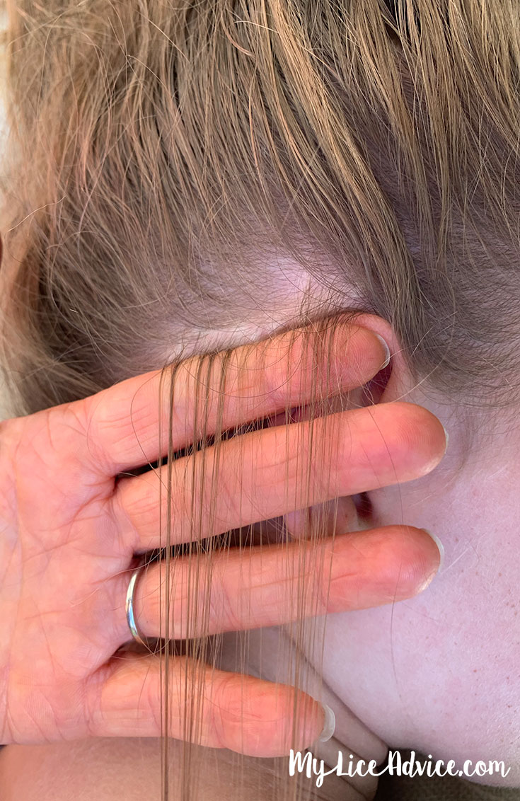 How To Check Your Child S Head For Lice Simple Steps With Pictures