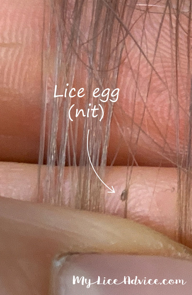 How To Check Your Child S Head For Lice Simple Steps With Pictures