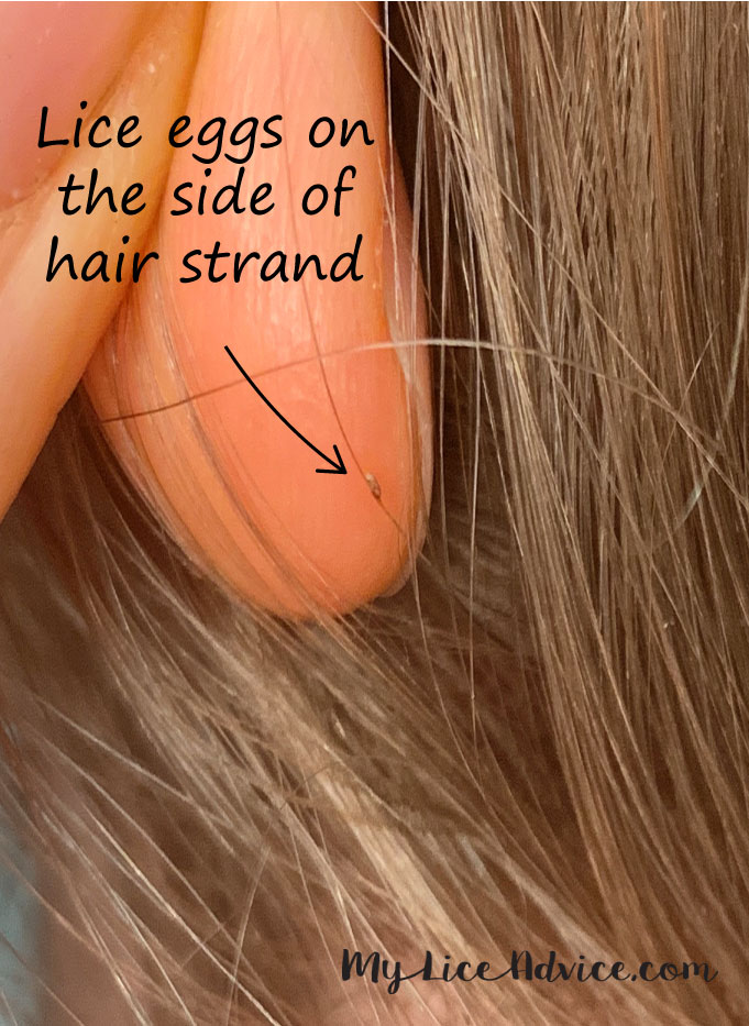 A two-toned golden-brown lice egg (nit) on a single hair strand with an arrow showing that it is on the side of the hair strand