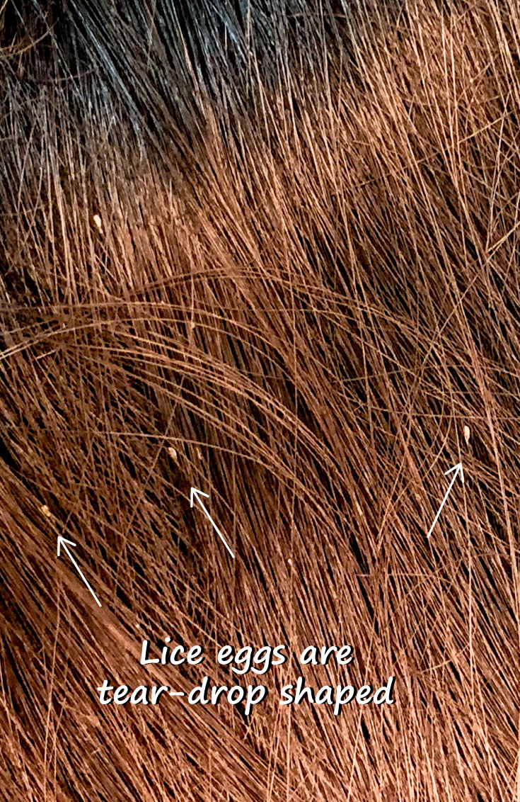 Three tear-drop shaped lice eggs are shown in red hair.
