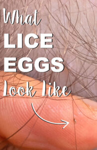 Lice egg on a hair strand with the backdrop of a finger. The words "What lice eggs look like" with an arrow pointing to the nit