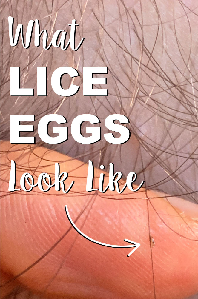 Lice egg on a hair strand with the backdrop of a finger. The words "What lice eggs look like" with an arrow pointing to the nit