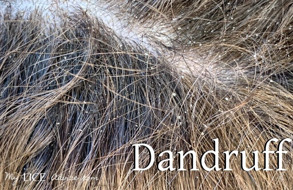 brunettes' hair with significant dandruff