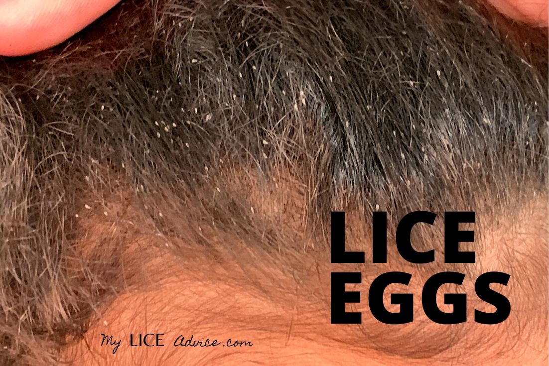 A woman with brown hair. Multiple lice eggs cover the back of her head. The white eggs appear white. The words LICE EGGS in black lettering are in the bottom right corner of the image.