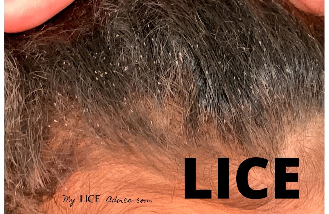 head lice eggs vs dandruff