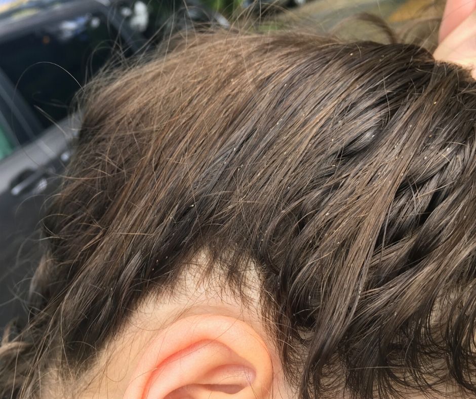 A woman's hair (brown) with white lice eggs in the hair. This woman has a serious infestation and has had lice for 3 years.