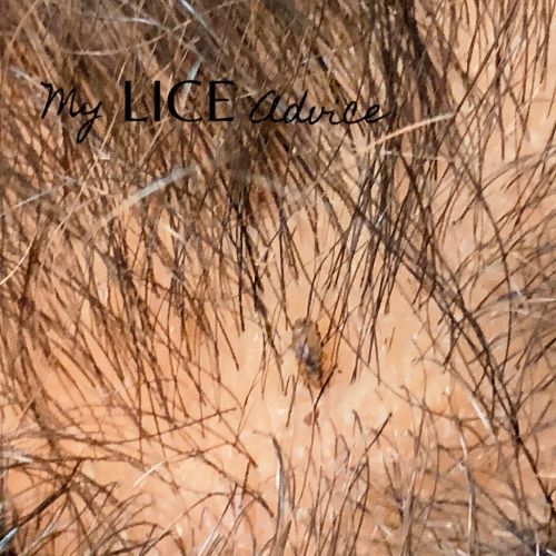 Black head lice