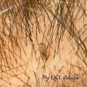 A lice bug on a hair strand near the scalp.