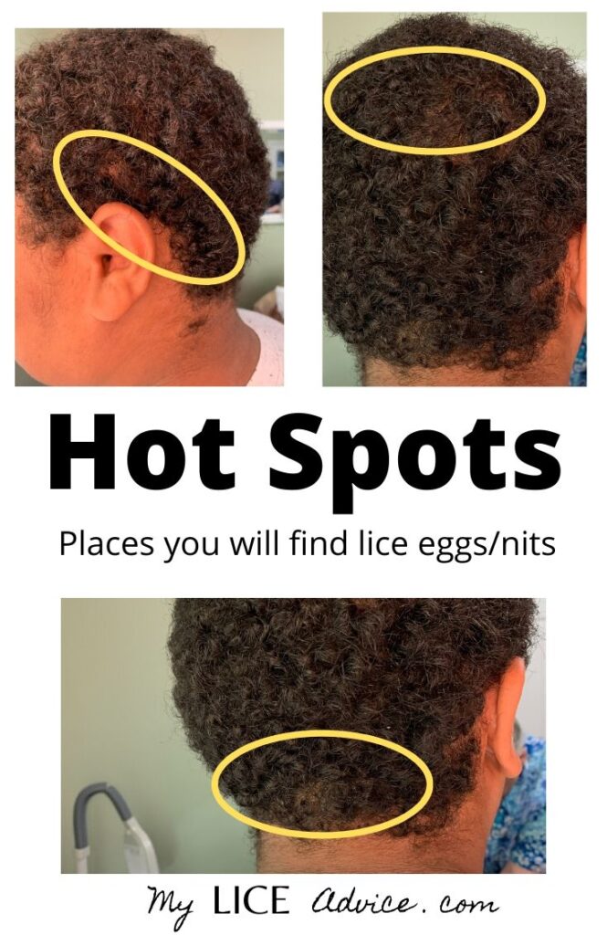 Black Lice and Lice in Black Hair (with Pictures) My Lice Advice