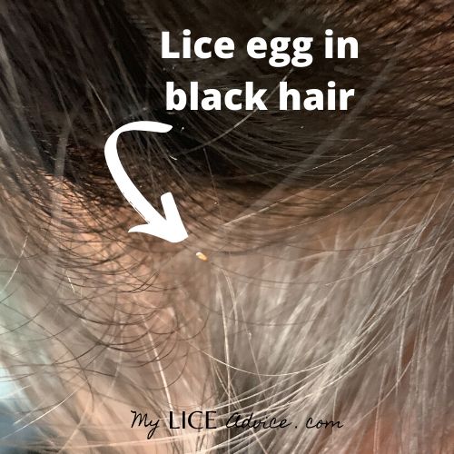 lice egg in very dark brown almost black hair