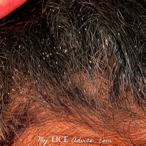 Lice eggs in black hair