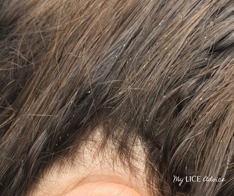 Lice eggs in brown hair