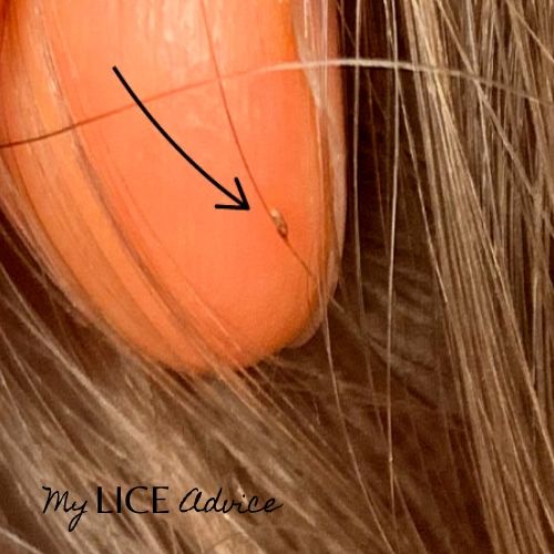 brown lice egg on the side of a hair strand