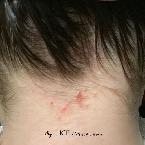 The back of a woman's neck with small red bumps