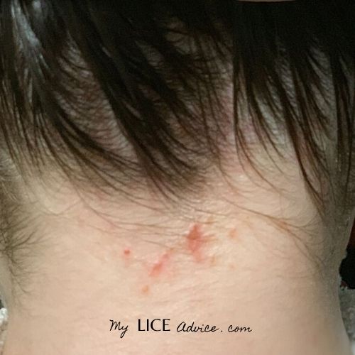 Skin Lice Symptoms