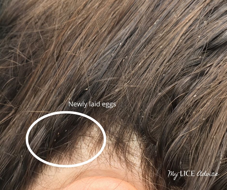 A woman with lice eggs near the scalp. The lice eggs are likely new.