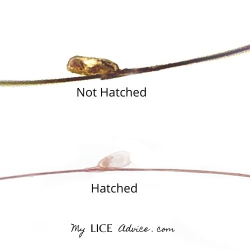 Two lice eggs (nits) are attached to different hair strands. The top lice egg is not hatched and is golden brown in color. The hatched lice egg is transparent/white.