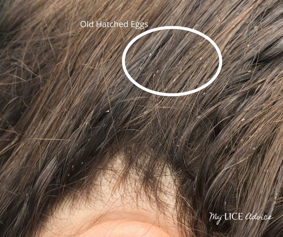 A woman with lice eggs attached to her hair. The eggs are attached further down the hair strand (away from her scalp). These eggs are likely already hatched and the woman has likely had lice for a long time.