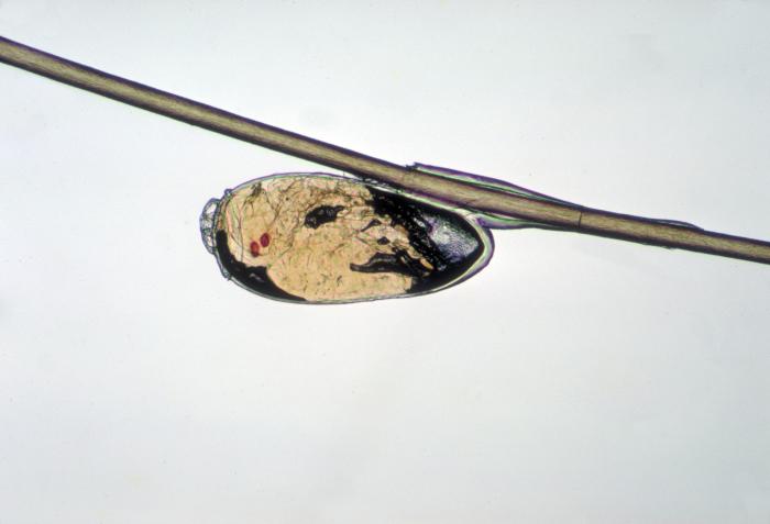 A brown/black lice egg (nit) attached to the side of a brown hair strand.