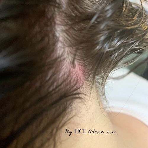 The back of a girl's neck, the scalp is red/pink at the base of the hair