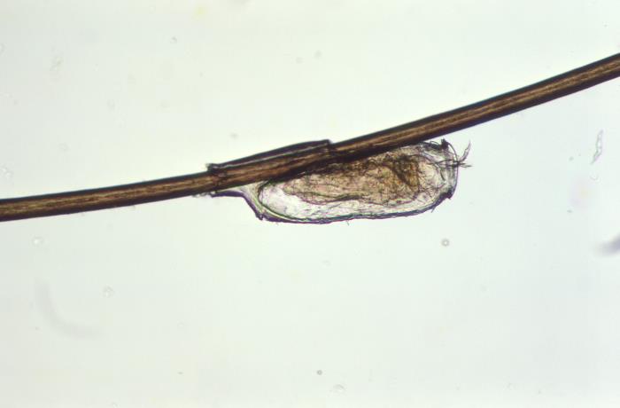An uclose picture of an unhatched lice egg (nit). The nit is attached to the side of a brown hair strand and is golden in color.