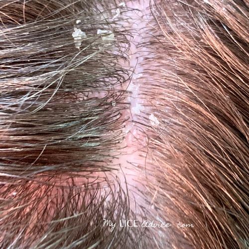 The top of a woman's head with large chunks of dandruff