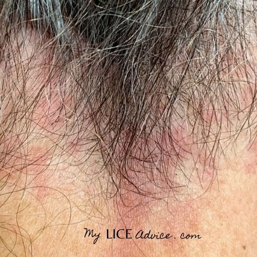 17 Lice Symptoms With Pictures Signs That You Have Head Lice My