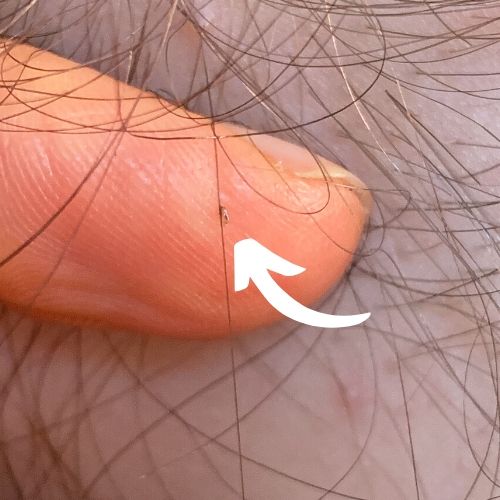 A lice egg (nit) is attached to a hair strand. A finger in behind the nit and a white arrow points at the nit.