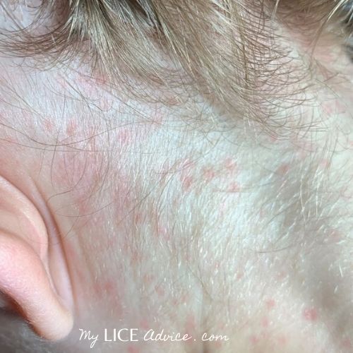 Rash Behind The Ear Causes Other Symptoms Of Rash On 