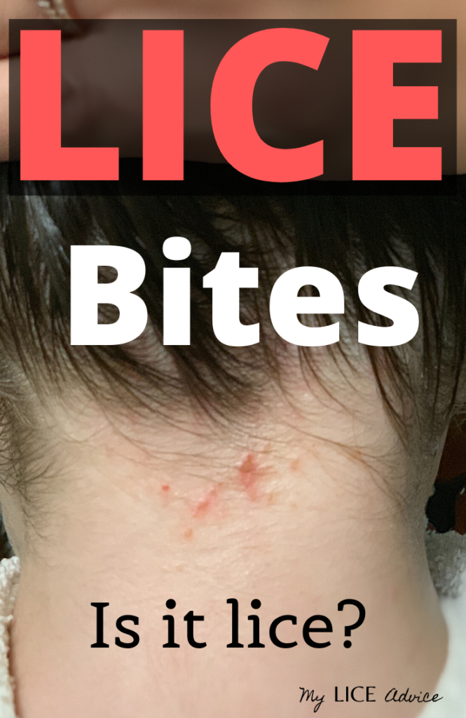 A Closer Look At Lice Bites And Rashes With Pictures My Lice Advice