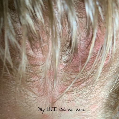 lice rash in blonde's hair