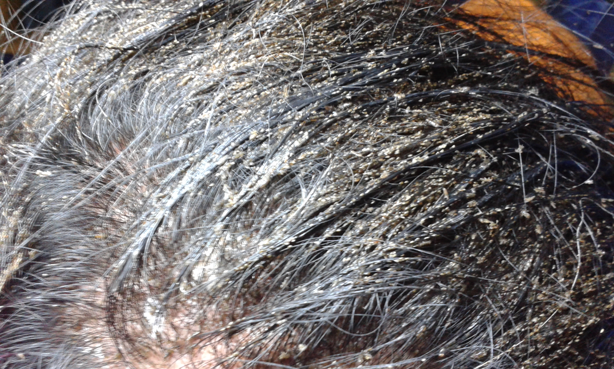 Thousands of lice eggs and nits in dark hair