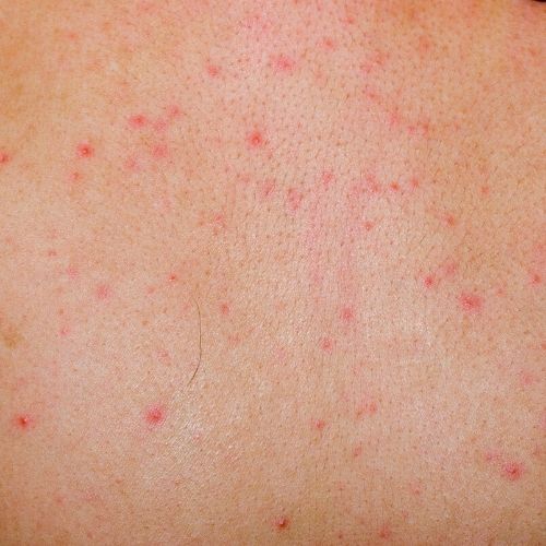 A Closer Look At Lice Bites And Rashes With Pictures My Lice Advice