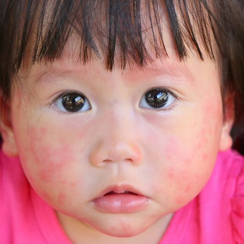 child with rash on the face