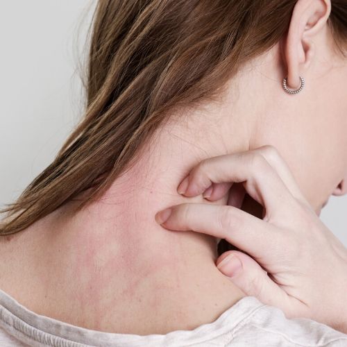 woman scratching her neck, has red scratch marks on the back of the neck