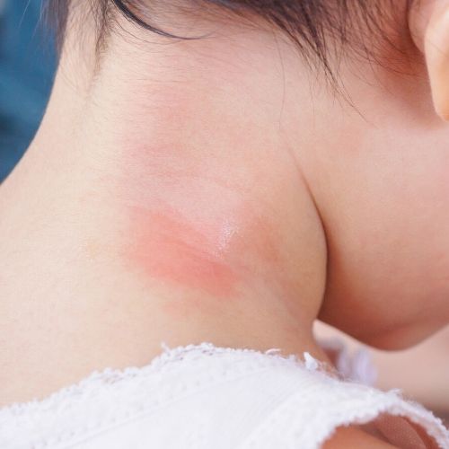 a child's neck skin burned presumably from home remedy lice treatment