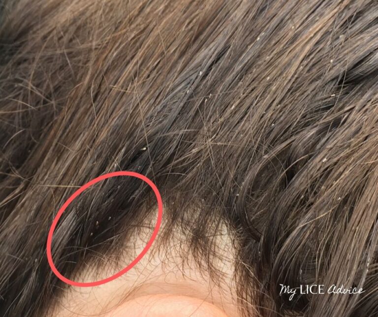 Shaving and Cutting Hair For Head Lice - My Lice Advice