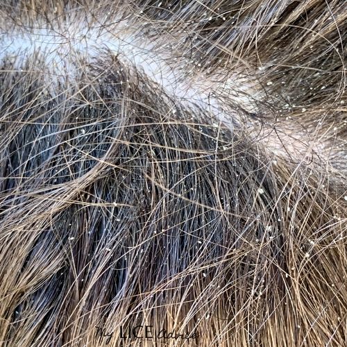 Close up of a woman with dandruff