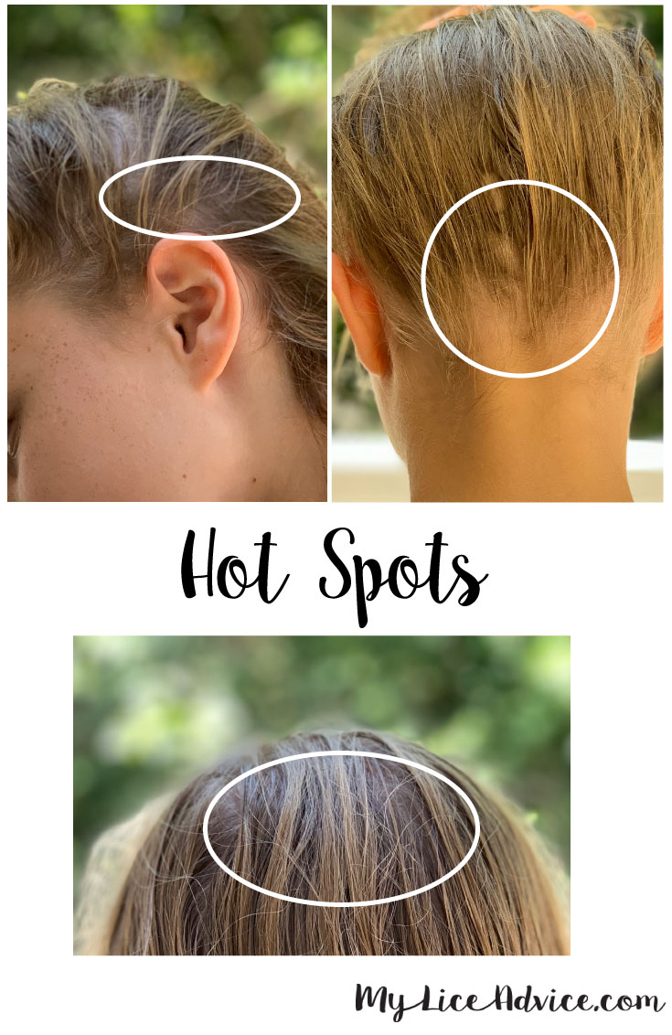 side-by-side images of blond girl's hair. Three circles identify the hot spots that lice usually lay lice eggs (nits)
