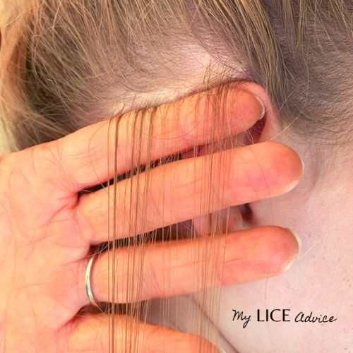 A girl is being checked for lice behind the ear