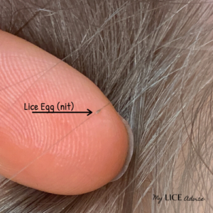 A single lice egg in hair found while checking for lice
