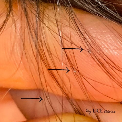 Close up of three lice eggs (nits) in brown hair with arrows pointing to nits.